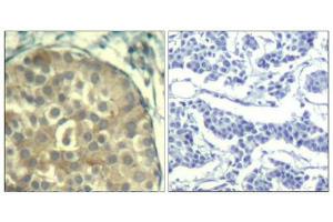 Immunohistochemical analysis of paraffin-embedded human breast carcinoma tissue using cofilin1/cofilin2(Phospho-Tyr88) Antibody(left) or the same antibody preincubated with blocking peptide(right). (Cofilin1/2 (CFL1/2) (pTyr88) antibody)