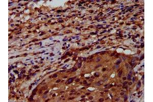 IHC image of ABIN7151198 diluted at 1:600 and staining in paraffin-embedded human lung cancer performed on a Leica BondTM system. (RNF43 antibody  (AA 566-697))