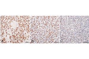 Immunohistochemistry with anti-matrix metalloproteinase 1 (MMP-1) primary antibody with positive reaction visible as brown staining. (MMP1 antibody  (C-Term))
