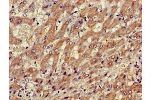 Immunohistochemistry of paraffin-embedded human liver cancer using ABIN7175883 at dilution of 1:100 (XBP1 antibody  (AA 1-167))