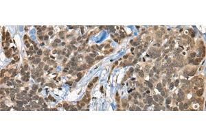 Immunohistochemistry of paraffin-embedded Human thyroid cancer tissue using CBFA2T3 Polyclonal Antibody at dilution of 1:45(x200) (CBFA2T3 antibody)
