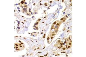Immunohistochemistry of paraffin-embedded human breast cancer using HNRNPA1 Antibody (ABIN5975570) at dilution of 1/100 (40x lens). (HNRNPA1 antibody)