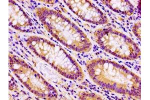 IHC image of ABIN7171142 diluted at 1:100 and staining in paraffin-embedded human colon cancer performed on a Leica BondTM system. (SNAP23 antibody  (AA 90-196))