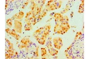 Immunohistochemical of paraffin-embedded Human lung cancer tissue using ABIN7172317 at dilution of 1:200. (p53 antibody)