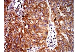 Immunohistochemical analysis of paraffin-embedded ovarian cancer tissues using UFD1L mouse mAb with DAB staining. (UFD1L antibody  (AA 208-307))