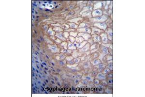 CDCA8 Antibody (N-term) (ABIN656687 and ABIN2845924) immunohistochemistry analysis in formalin fixed and paraffin embedded human esophageal carcinoma followed by peroxidase conjugation of the secondary antibody and DAB staining.