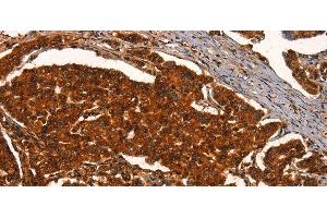 Immunohistochemistry of paraffin-embedded Human breast cancer using PRKD1 Polyclonal Antibody at dilution of 1:40 (PKC mu antibody)