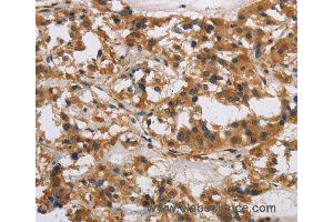 Immunohistochemistry of Human gastric cancer using IL17RB Polyclonal Antibody at dilution of 1:40 (IL17 Receptor B antibody)
