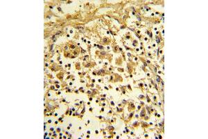 Formalin-fixed and paraffin-embedded human lymph reacted with ENO1 Antibody (Center), which was peroxidase-conjugated to the secondary antibody, followed by DAB staining. (ENO1 antibody  (AA 178-205))