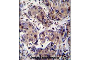 MAGEA3 Antibody immunohistochemistry analysis in formalin fixed and paraffin embedded human breast carcinoma followed by peroxidase conjugation of the secondary antibody and DAB staining. (MAGEA3 antibody  (C-Term))