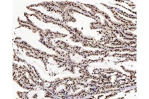 Immunohistochemistry analysis of paraffin-embedded human stomach cancer using c-Fos Polyclonal Antibody at dilution of 1:200. (c-FOS antibody)