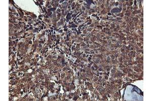 Immunohistochemical staining of paraffin-embedded Adenocarcinoma of Human breast tissue using anti-AKT1 mouse monoclonal antibody.