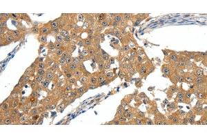 Immunohistochemistry of paraffin-embedded Human breast cancer tissue using SCN5A Polyclonal Antibody at dilution 1:30 (SCN5A antibody)