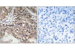 Immunohistochemistry analysis of paraffin-embedded human breast carcinoma tissue, using MAP3K7 (Ab-187) Antibody. (MAP3K7 antibody  (AA 161-210))