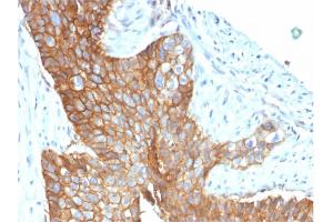 Formalin-fixed, paraffin-embedded human Cervical Carcinoma stained with CD9 Mouse Monoclonal Antibody (CD9/1619). (CD9 antibody)