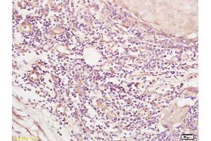 Formalin-fixed and paraffin embedded human breast carcinoma tissue labeled with Anti SGK3 Polyclonal Antibody,Unconjugated (ABIN1387590) at 1:200 followed by conjugation to the secondary antibody and DAB staining. (SGK3 antibody  (AA 40-90))