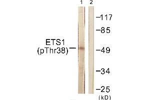 Immunohistochemistry analysis of paraffin-embedded human breast carcinoma tissue using ETS1 (Phospho-Thr38) antibody. (ETS1 antibody  (pThr38))