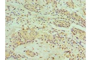 Immunohistochemistry of paraffin-embedded human breast cancer using ABIN7155132 at dilution of 1:100 (HNRNPM antibody  (AA 491-730))