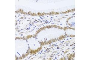 Immunohistochemistry of paraffin-embedded human gastric cancer using MCM4 Antibody (ABIN5971548) at dilution of 1/100 (40x lens). (MCM4 antibody)
