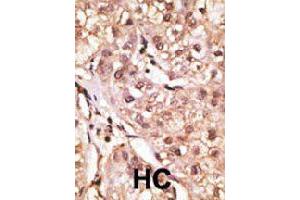 Formalin-fixed and paraffin-embedded human hepatocellular carcinoma tissue reacted with IL29 polyclonal antibody  , which was peroxidase-conjugated to the secondary antibody, followed by DAB staining.