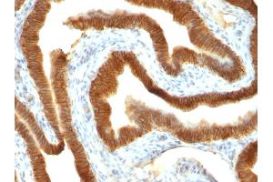 Formalin-fixed, paraffin-embedded human Colon Carcinoma stained with Ep-CAM Mouse Monoclonal Antibody (VU-1D9). (EpCAM antibody)