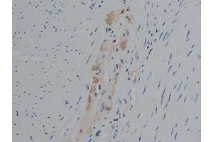 ABIN6267420 at 1/50 staining human colon carcinoma tissue sections by IHC-P. (Phospholipase C gamma 1 antibody  (pTyr771))