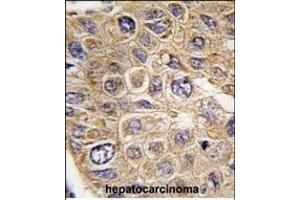 Formalin-fixed and paraffin-embedded human hepatocarcinoma tissue reacted with FDFT1 Antibody (Center) (ABIN389052 and ABIN2839261) , which was peroxidase-conjugated to the secondary antibody, followed by DAB staining. (FDFT1 antibody  (AA 140-170))