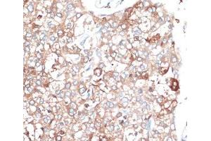 Immunohistochemistry of paraffin-embedded Human liver cancer using SLAMF7 Polyclonal Antibody at dilution of 1:100 (40x lens). (SLAMF7 antibody)