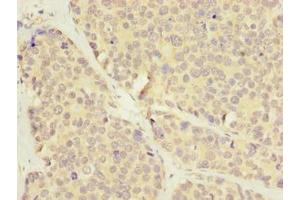 Immunohistochemistry of paraffin-embedded human gastric cancer using ABIN7175622 at dilution of 1:100 (LRRC8E antibody  (AA 353-630))