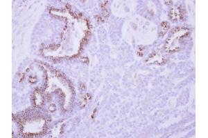 IHC-P Image Immunohistochemical analysis of paraffin-embedded human breast cancer, using MCL1, antibody at 1:250 dilution. (MCL-1 antibody  (Center))