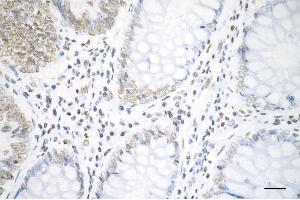 Immunohistochemistry was performed on paraffin-embedded human sigmoid colon carcinoma using histone H3 (acetyl K19) antibody (ABIN7798970), 1:200). (Recombinant Histone 3 antibody  (H3K18ac))