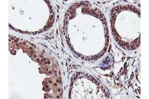 Immunohistochemical staining of paraffin-embedded Human breast tissue using anti-DUSP23 mouse monoclonal antibody. (DUSP23 antibody)