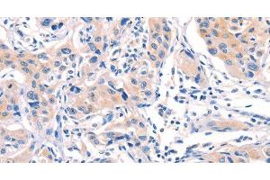 Immunohistochemistry of paraffin-embedded Human lung cancer tissue using AFDN Polyclonal Antibody at dilution 1:40 (Afadin antibody)