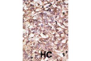 Formalin-fixed and paraffin-embedded human hepatocellular carcinoma tissue reacted with DKK4 polyclonal antibody  , which was peroxidase-conjugated to the secondary antibody, followed by DAB staining. (DKK4 antibody  (C-Term))