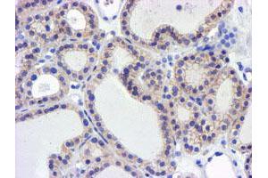Immunohistochemical staining of paraffin-embedded Carcinoma of Human thyroid tissue using anti-GSTO2 mouse monoclonal antibody. (GSTO2 antibody)