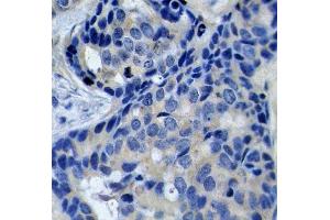 Immunohistochemistry of paraffin-embedded human breast carcinoma using Phospho-PTK2B-Y402 antibody (ABIN2987623). (PTK2B antibody  (pTyr402))
