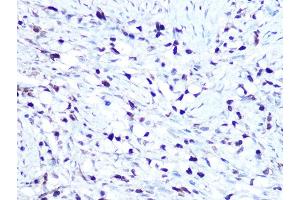 Immunohistochemistry of paraffin-embedded human oophoroma using HMG Rabbit mAb (ABIN7267646) at dilution of 1:100 (40x lens). (HMGA1 antibody)