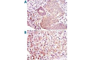 Immunohistochemical analysis of paraffin-embedded human ovarian cancer (A) and kidney cancer (B) using MAP2K6 monoclonal antibody, clone 3H12B9  with DAB staining. (MAP2K6 antibody)