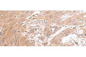 Immunohistochemistry of paraffin-embedded Human esophagus cancer tissue using CHST4 Polyclonal Antibody at dilution of 1:35(x200) (CHST4 antibody)