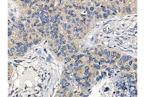 p130 Cas Mouse Monoclonal Antibody at 1/100 staining human lung cancer and adjacent non-tumor tissue by IHC-P.