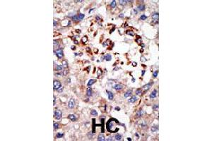 Formalin-fixed and paraffin-embedded human hepatocellular carcinoma tissue reacted with CBX8 polyclonal antibody  , which was peroxidase-conjugated to the secondary antibody, followed by DAB staining . (CBX8 antibody  (C-Term))