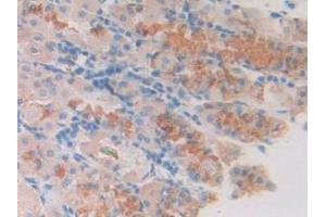 IHC-P analysis of Human Stomach Cancer Tissue, with DAB staining. (SLIT1 antibody  (AA 647-835))