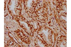 IHC image of ABIN7155735 diluted at 1:600 and staining in paraffin-embedded human prostate cancer performed on a Leica BondTM system. (HOXB3 antibody  (AA 315-423))