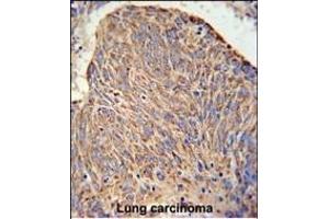 C Antibody (Center) (ABIN650934 and ABIN2840000) IHC analysis in formalin fixed and paraffin embedded human lung carcinoma followed by peroxidase conjugation of the secondary antibody and DAB staining. (CCDC130 antibody  (AA 173-200))