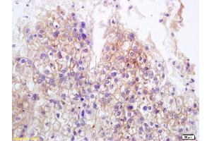 Formalin-fixed and paraffin embedded human lung carcinoma labeled with Anti-MICB Polyclonal Antibody, Unconjugated (ABIN1385296) at 1:200 followed by conjugation to the secondary antibody and DAB staining. (MICA/B antibody  (AA 81-180))