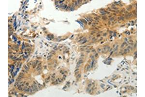 The image on the left is immunohistochemistry of paraffin-embedded Human colon cancer tissue using ABIN7190314(CMTM7 Antibody) at dilution 1/30, on the right is treated with synthetic peptide. (CMTM7 antibody)