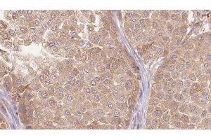 ABIN6277619 at 1/100 staining Human Melanoma tissue by IHC-P. (IL-27 antibody  (Internal Region))