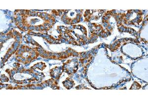 Immunohistochemistry of paraffin-embedded Human thyroid cancer using ALDH6A1 Polyclonal Antibody at dilution of 1:45 (ALDH6A1 antibody)