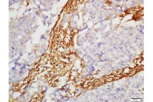 Formalin-fixed and paraffin embedded human lung carcinoma labeled with Anti-SLC7A5 Polyclonal Antibody, Unconjugated  at 1:200 followed by conjugation to the secondary antibody and DAB staining (SLC7A5 antibody  (AA 101-200))