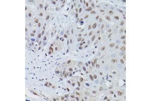 Immunohistochemistry of paraffin-embedded human esophageal cancer using MRE11 Rabbit pAb (ABIN3016249, ABIN3016250, ABIN3016251 and ABIN6219660) at dilution of 1:50 (40x lens). (Mre11 antibody  (AA 1-205))